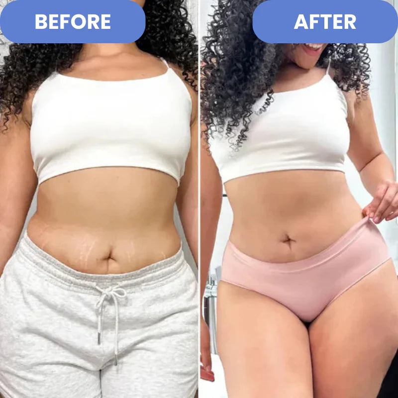 SculptEase – zabieg na cellulit 4 w 1