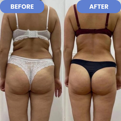 SculptEase - Cellulite Treatment 4-in-1